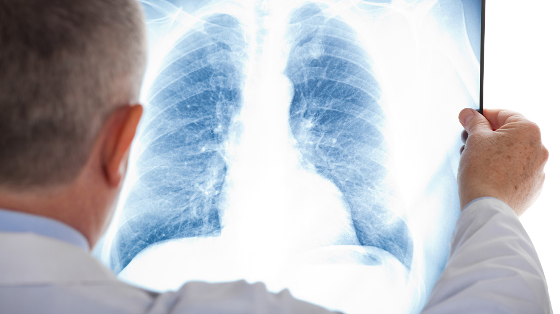 Une étude de l'AIEA montre que l'amélioration des services d'imagerie  médicale et de médecine nucléaire contribue à mieux traiter les patients  atteints de cancer du poumon dans le monde entier | AIEA