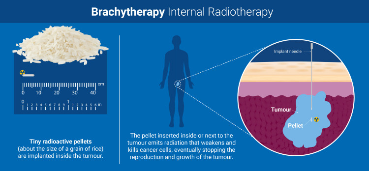 systemic radiation therapy