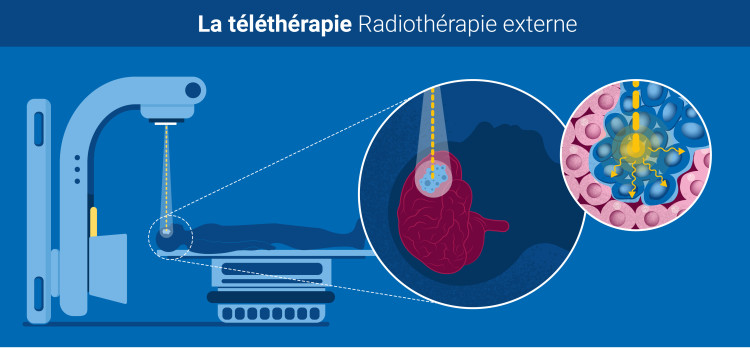 Qu'est-ce que la radiothérapie ? | AIEA